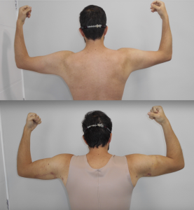 Lipo HD braços em homem