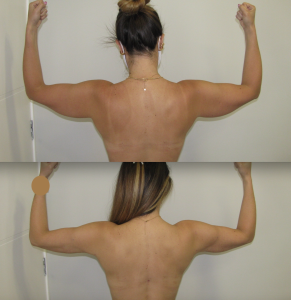 Lipo HD braços