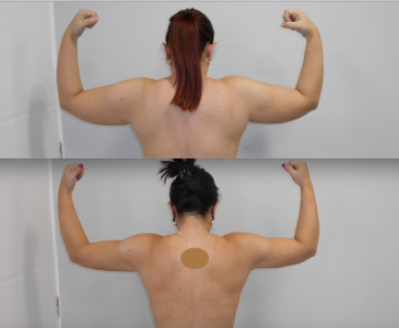 Lipo HD braços PO 10 meses 