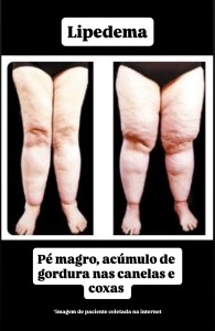 Lipedema - características anatómicas