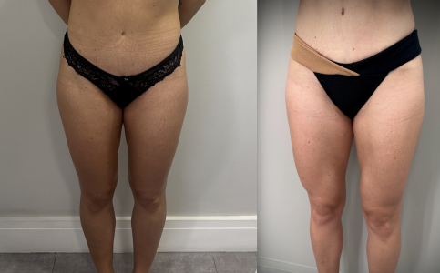 Lipo HD COXAS 