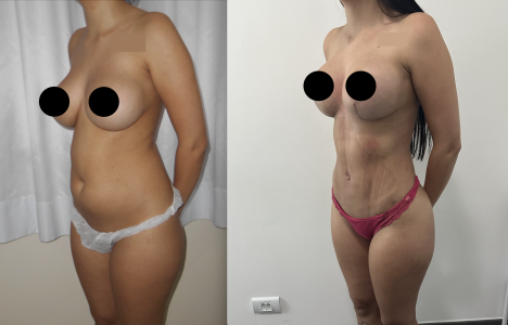 Lipo HD PO 30 dias