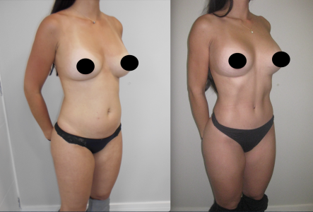 Abdominoplasita