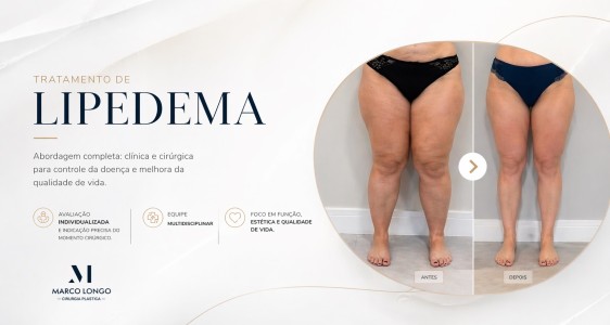 Lipedema