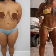 Lipo HD coxas