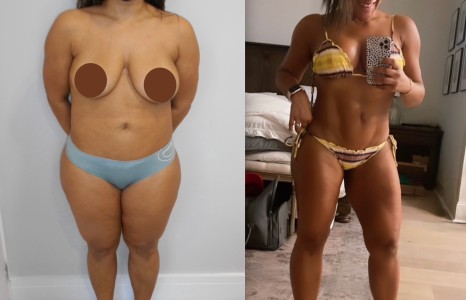 Lipo HD coxas