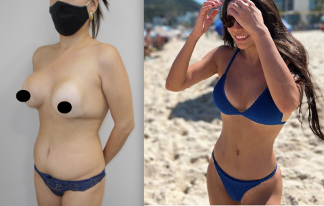 Mommy MakeOver - Dr Marco Longo