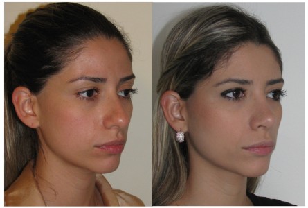 rinoplastia Dr Marco Longo
