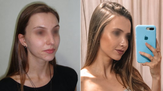 rinoplastia dr Marco Longo