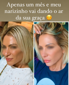 rinoplastia dr Marco Longo