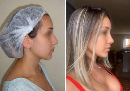 rinoplastia dr Marco Longo